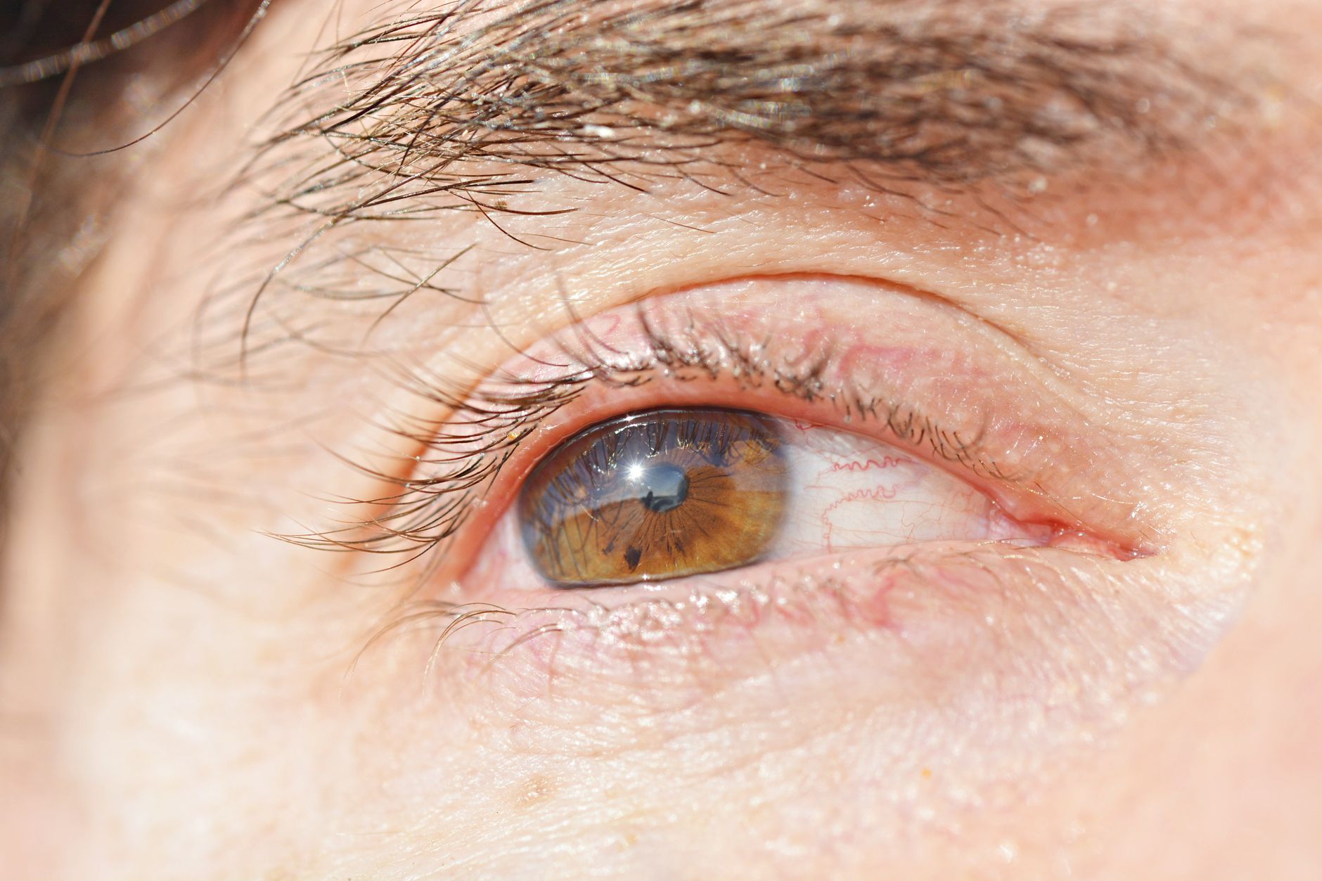 How to Discuss Eyelid Eczema with Your Doctor - educational article image