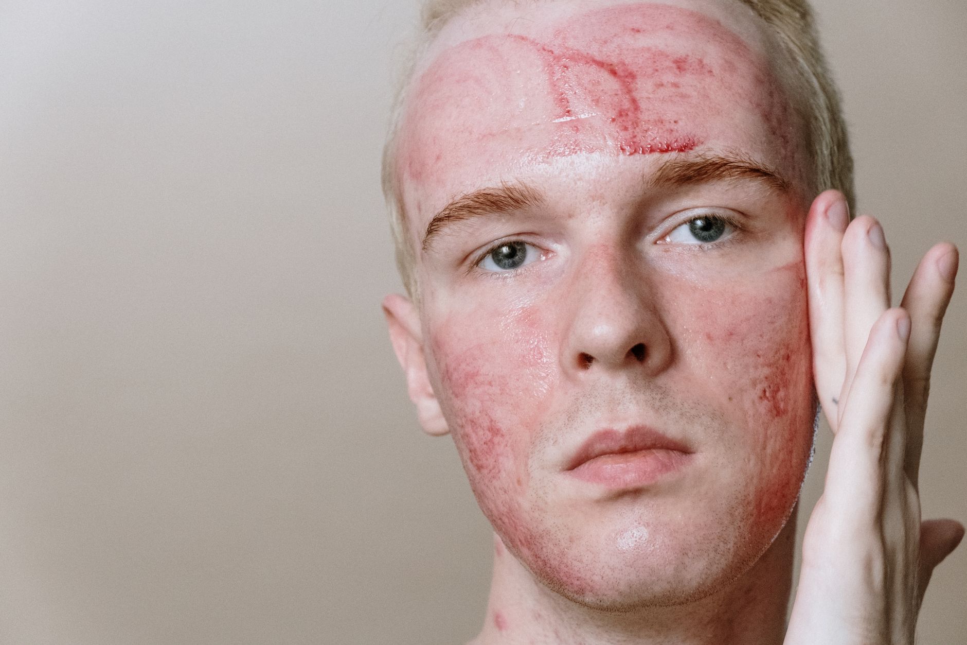 Facial Eczema Acne Rosacea: Practical Guide - educational article image